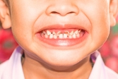 Лечение кариеса молочных зубов у детей раннего возраста